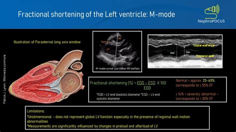 lv fractional shortening